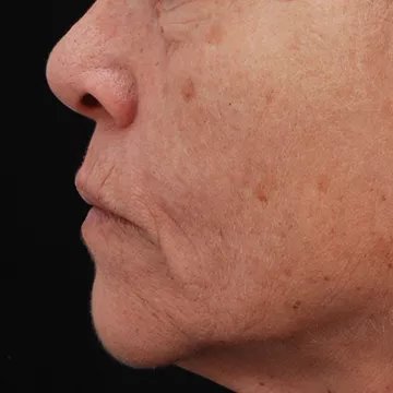 Appareil anti rides NEWA anti-age visage