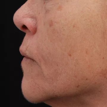 Appareil anti rides NEWA anti-age visage