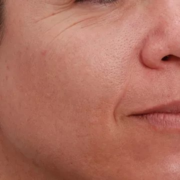 Appareil anti rides NEWA anti-age visage