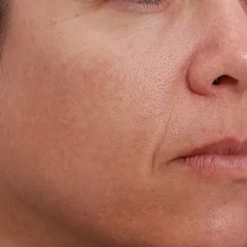 Appareil anti rides NEWA anti-age visage